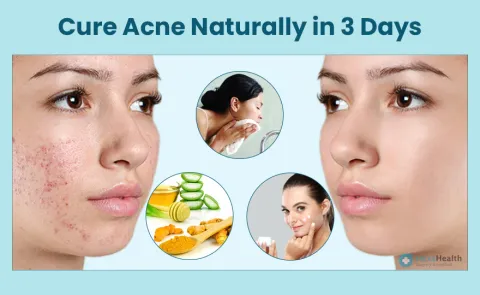 Reduce Acne Naturally